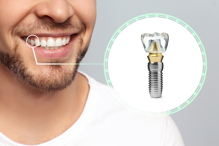 Why Are Dental Implants So Popular?