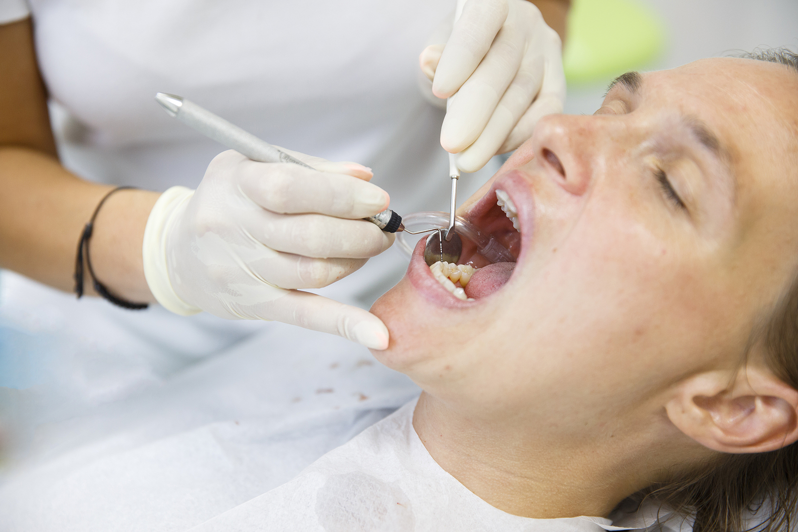 The Benefits of Root Canal Treatment: Why Saving Your Tooth is Worth It